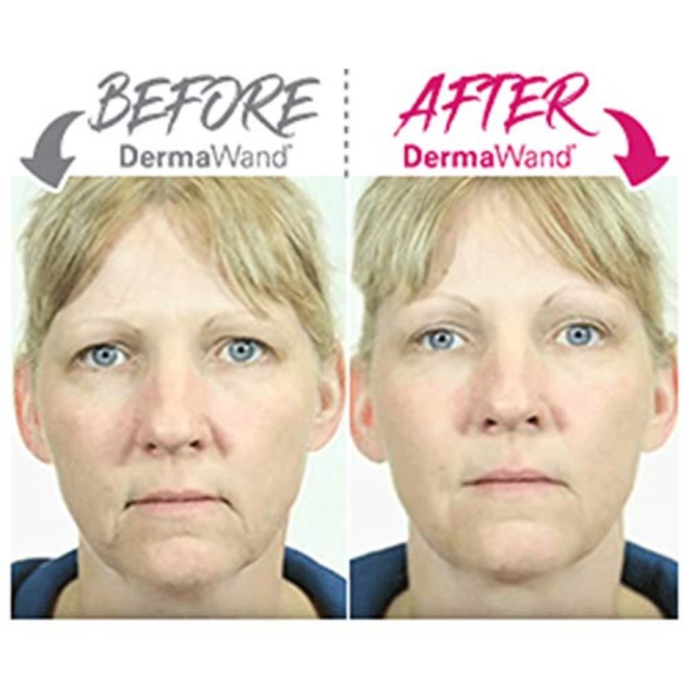 DermaWand PRO Newest Model - 50% Stronger Than The Original - BNIB - Picture 4 of 16
